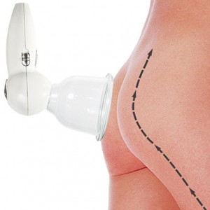 409-39213-Prorelax-Vakuum-Massagegeraet-Prorelax-Vakuumm