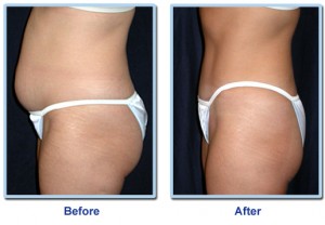 femenina-abs-antes-y-después-antes-después-amp-estómago.
