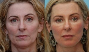 antes y después de la lipofilling cara