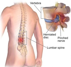 herniatet discos-01-6c-1 (1)